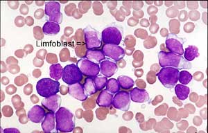 Leukemia Myeloid Kronis kronis, adalah bentuk limfoma